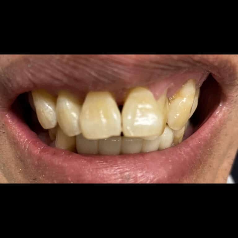 Before Image: Pont sur implants - front