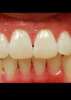 After Image: Blanchiment des dents - front