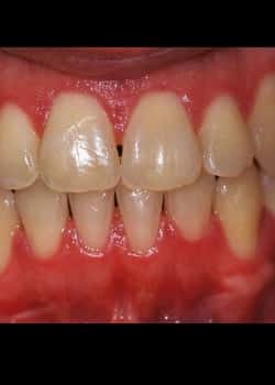 Before Image: Blanchiment des dents - front