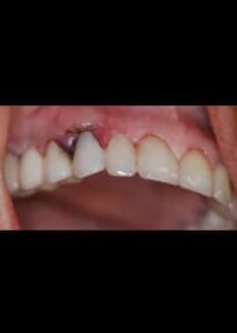 After Image: Implants Dentaires