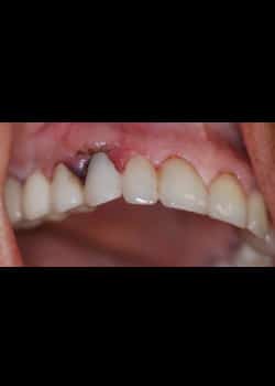 After Image: Implants Dentaires - front