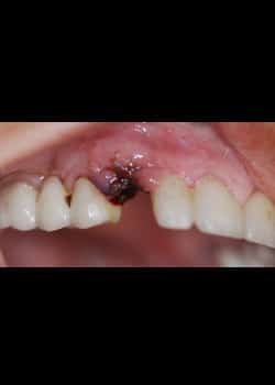 Before Image: Implants Dentaires - front