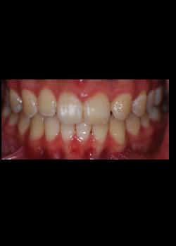 After Image: Invisalign - front