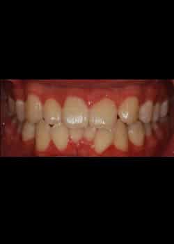 Before Image: Invisalign - front