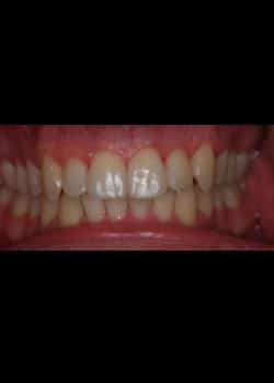 After Image: Invisalign - front