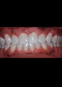After Image: Blanchiment des dents