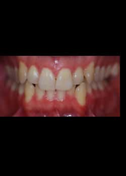 Before Image: Blanchiment des dents - Devant