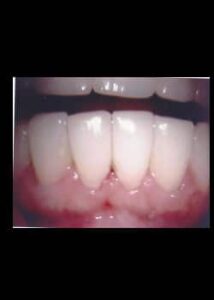 After Image: Sourire avec Facettes en composite (Métamorphose du Sourire)
