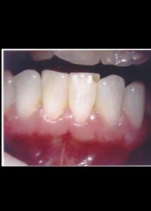 Before Image: Sourire avec Facettes en composite (Métamorphose du Sourire)