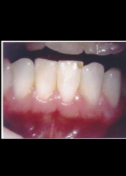 Before Image: Sourire avec Facettes en composite (Métamorphose du Sourire) - front