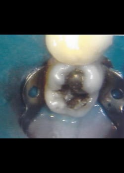 Before Image: La resine la même couleur de vos dents - front