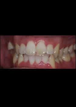 Before Image: Invisalign - front