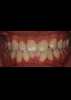 Before Image: Invisalign - front