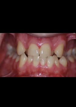 Before Image: Invisalign - front