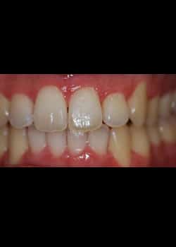 After Image: Invisalign - front
