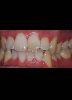 Before Image: Invisalign - front