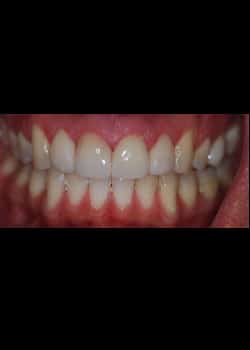 After Image: Invisalign - front