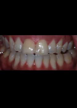 Before Image: Invisalign - front