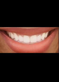 After Image: Invisalign - front