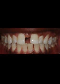 Before Image: Invisalign - front