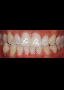 Before Image: Invisalign