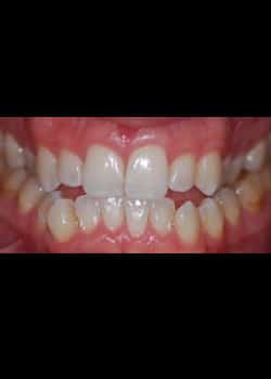 Before Image: Invisalign - front