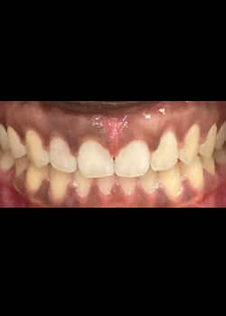 After Image: Invisalign - front