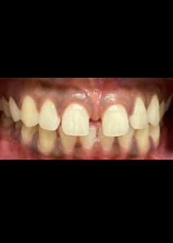 Before Image: Invisalign - front