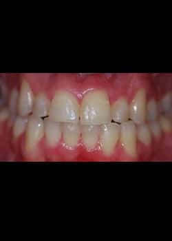 After Image: Invisalign - front