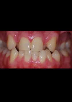 Before Image: Invisalign - front