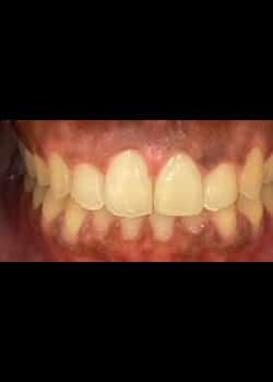 After Image: Invisalign - front