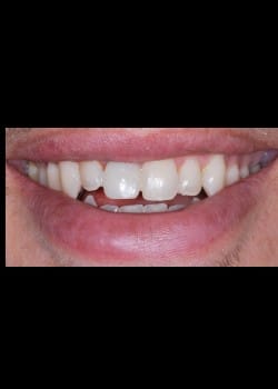 After Image: Implants Dentaires - front