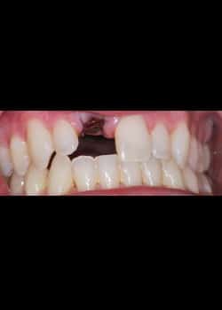 Before Image: Implants Dentaires - front