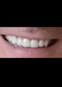 After Image: Facettes (Métamorphose du Sourire)
