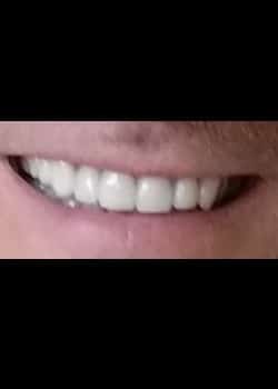 After Image: Facettes (Métamorphose du Sourire) - front