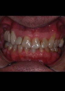 Before Image: Facettes (Métamorphose du Sourire)
