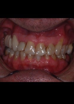Before Image: Facettes (Métamorphose du Sourire) - front