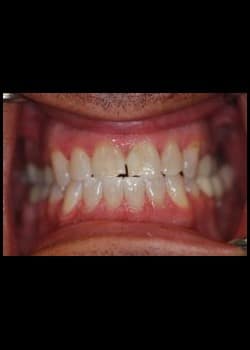 After Image: Blanchiment des dents - front
