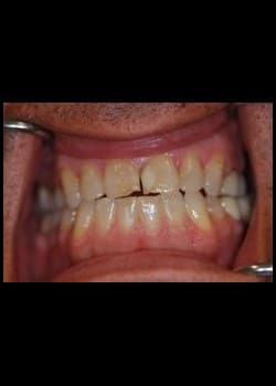 Before Image: Blanchiment des dents - front