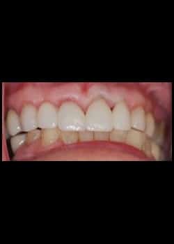 After Image: Couronnes en porcelaine (Métamorphose du Sourire) - front