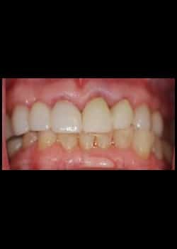Before Image: Couronnes en porcelaine (Métamorphose du Sourire) - front