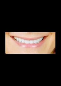 After Image: Facettes en porcelaine (Métamorphose du Sourire)