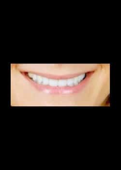 After Image: Facettes en porcelaine (Métamorphose du Sourire) - Devant