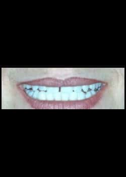 Before Image: Facettes en porcelaine (Métamorphose du Sourire) - Devant