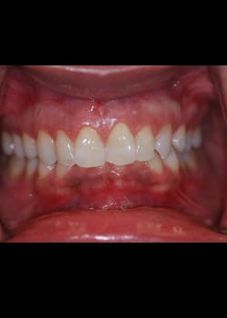 After Image: Blanchiment des Dents - front