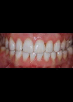 After Image: Invisalign - front