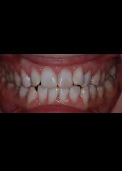 Before Image: Invisalign - front