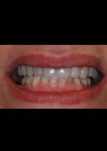 After Image: Facettes (Métamorphose du Sourire)