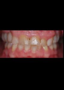 Before Image: Facettes (Métamorphose du Sourire)
