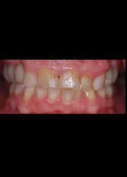 Before Image: Facettes (Métamorphose du Sourire) - Devant